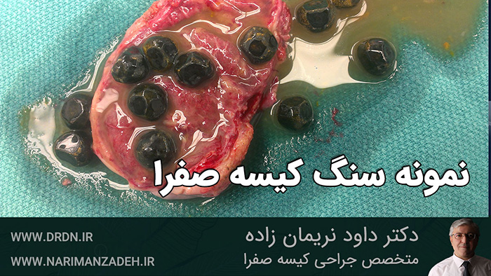 بهترین جراح کیسه صفرا